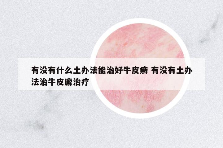 有沒有什么土辦法能治好牛皮癬 有沒有土辦法治牛皮廨治療