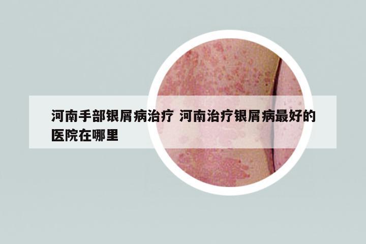 河南手部銀屑病治療 河南治療銀屑病最好的醫(yī)院在哪里