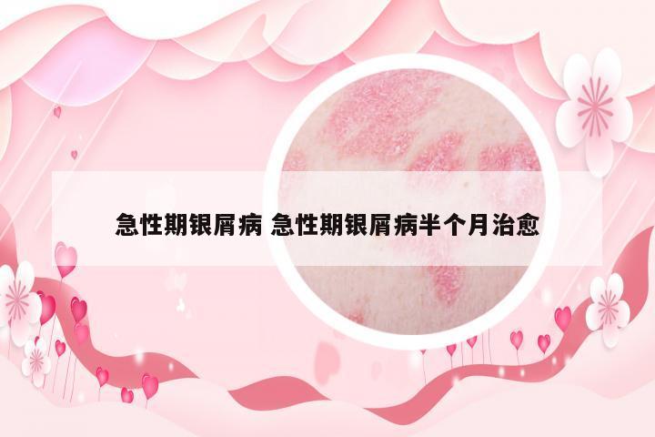 急性期銀屑病 急性期銀屑病半個(gè)月治愈