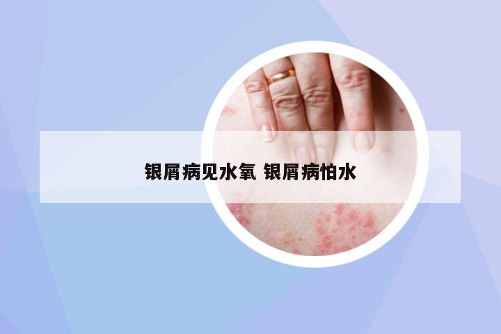 銀屑病見水氧 銀屑病怕水