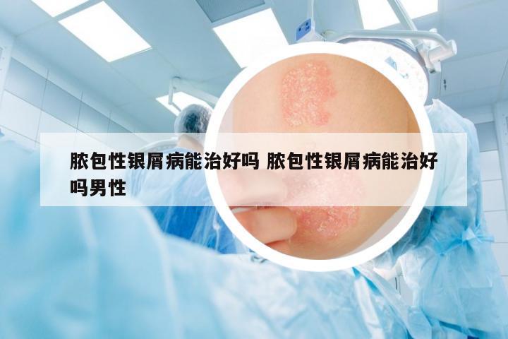 膿包性銀屑病能治好嗎 膿包性銀屑病能治好嗎男性