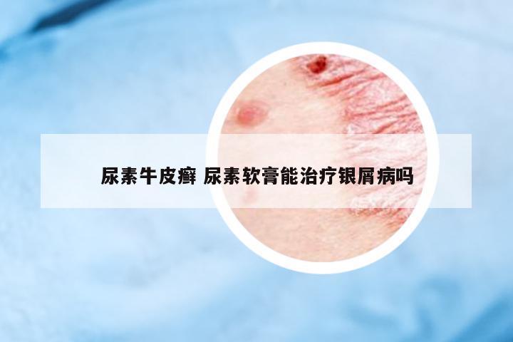 尿素牛皮癬 尿素軟膏能治療銀屑病嗎