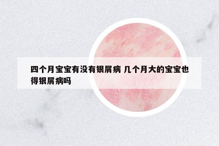 四個月寶寶有沒有銀屑病 幾個月大的寶寶也得銀屑病嗎