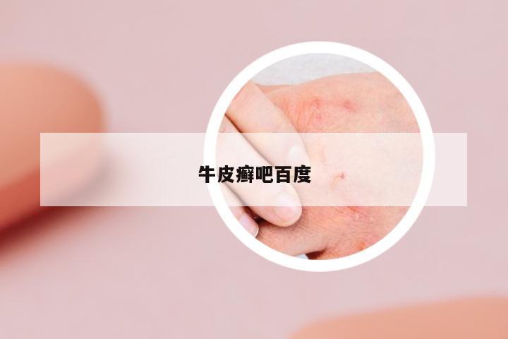 牛皮癬吧百度