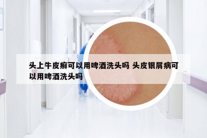 頭上牛皮癬可以用啤酒洗頭嗎 頭皮銀屑病可以用啤酒洗頭嗎