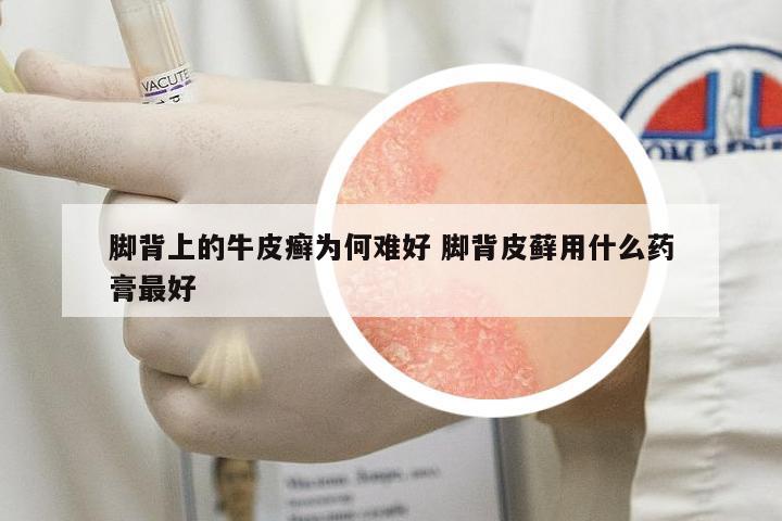 腳背上的牛皮癬為何難好 腳背皮蘚用什么藥膏最好