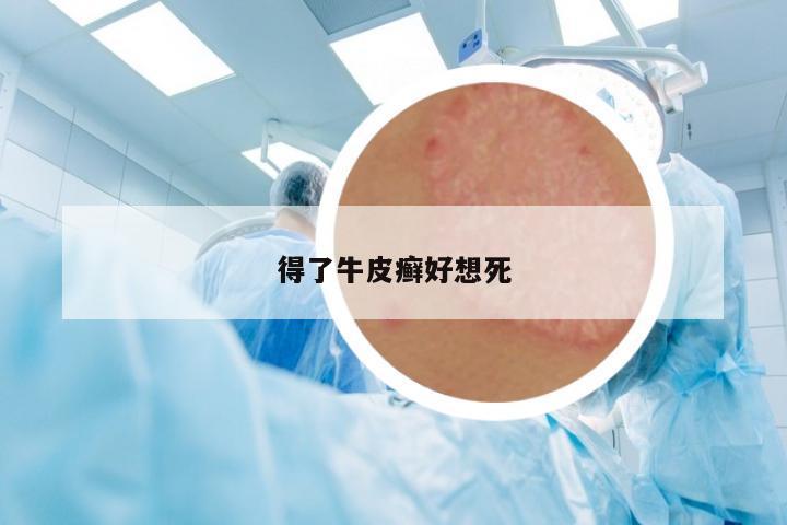 得了牛皮癬好想死