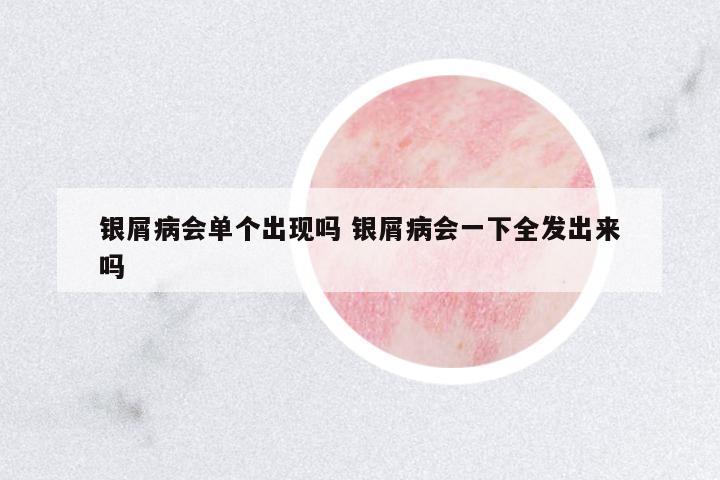 銀屑病會單個出現(xiàn)嗎 銀屑病會一下全發(fā)出來嗎