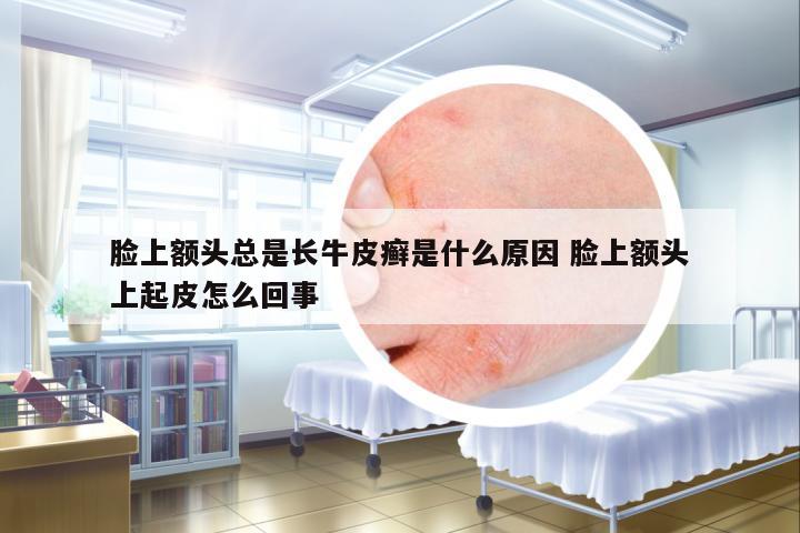 臉上額頭總是長牛皮癬是什么原因 臉上額頭上起皮怎么回事