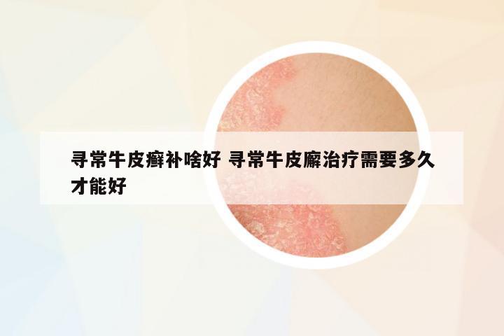 尋常牛皮癬補(bǔ)啥好 尋常牛皮廨治療需要多久才能好