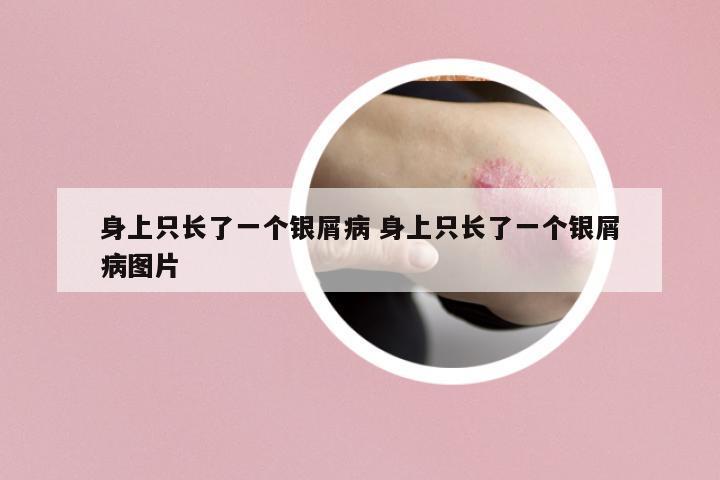 身上只長了一個(gè)銀屑病 身上只長了一個(gè)銀屑病圖片
