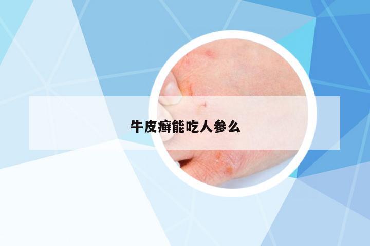 牛皮癬能吃人參么