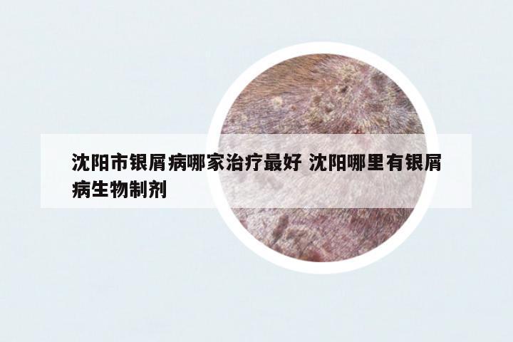 沈陽市銀屑病哪家治療最好 沈陽哪里有銀屑病生物制劑