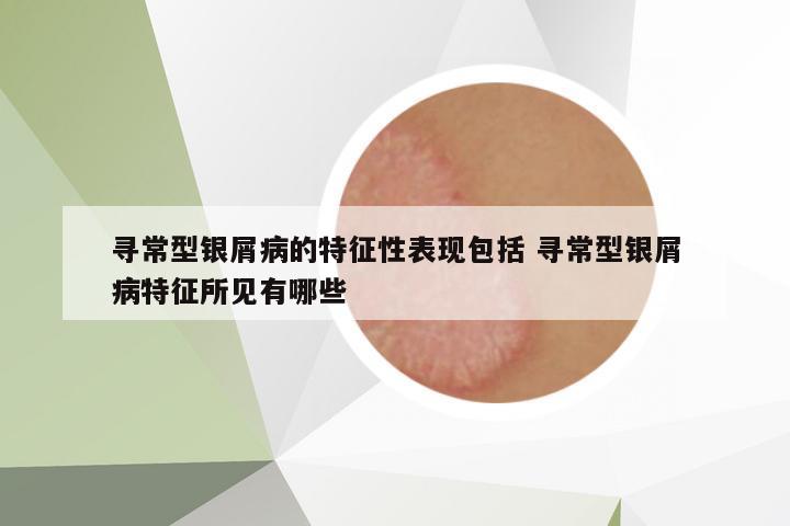 尋常型銀屑病的特征性表現(xiàn)包括 尋常型銀屑病特征所見(jiàn)有哪些