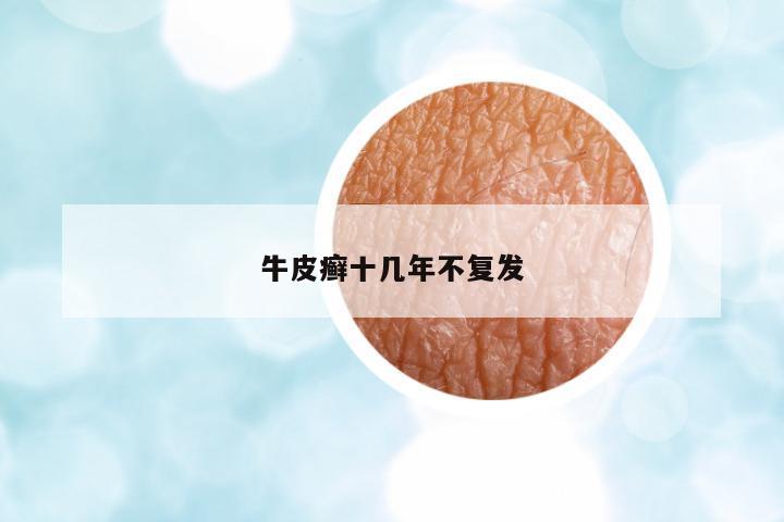 牛皮癬十幾年不復(fù)發(fā)