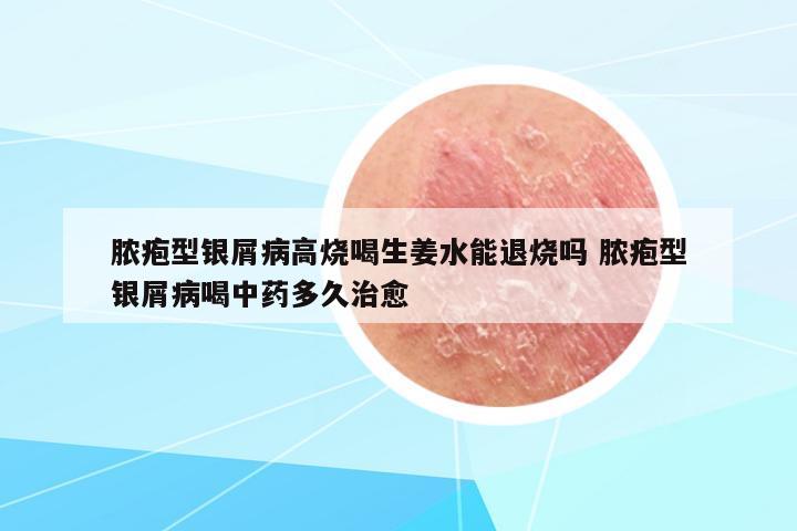 膿皰型銀屑病高燒喝生姜水能退燒嗎 膿皰型銀屑病喝中藥多久治愈