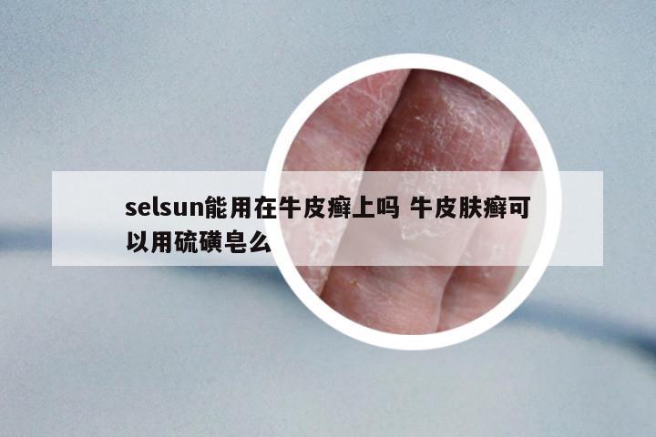 selsun能用在牛皮癬上嗎 牛皮膚癬可以用硫磺皂么