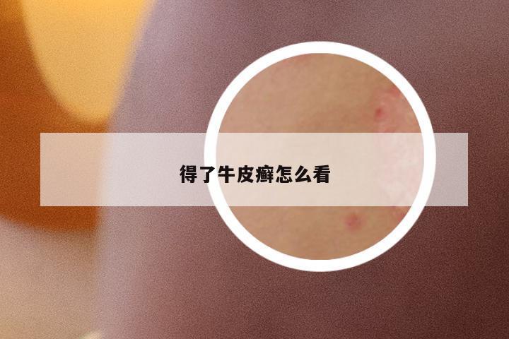 得了牛皮癬怎么看