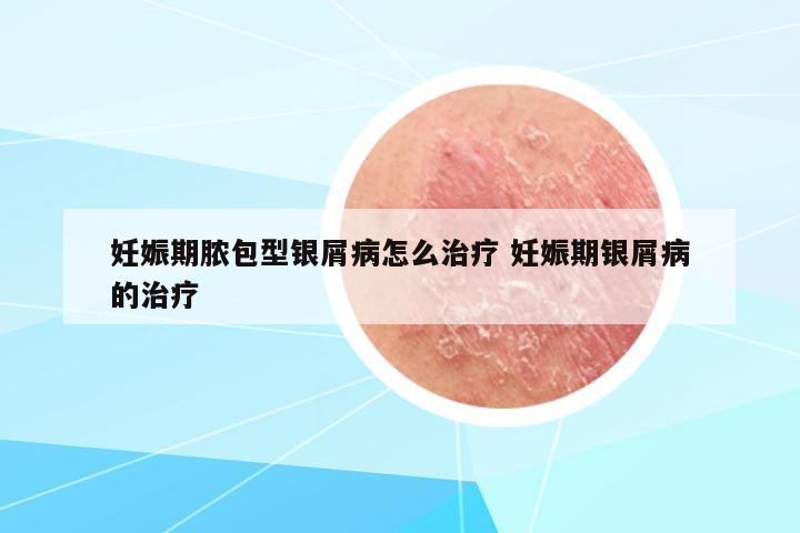妊娠期膿包型銀屑病怎么治療 妊娠期銀屑病的治療