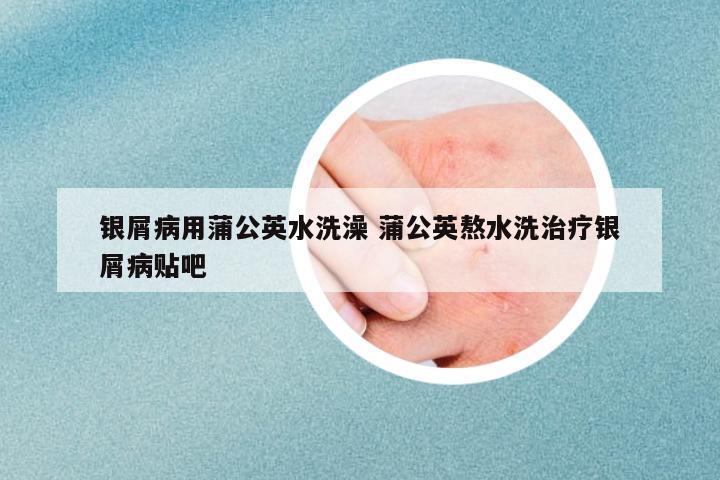 銀屑病用蒲公英水洗澡 蒲公英熬水洗治療銀屑病貼吧