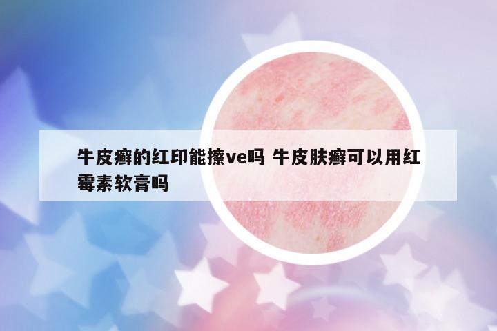 牛皮癬的紅印能擦ve嗎 牛皮膚癬可以用紅霉素軟膏嗎