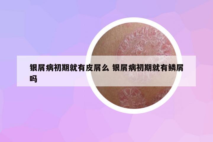 銀屑病初期就有皮屑么 銀屑病初期就有鱗屑嗎