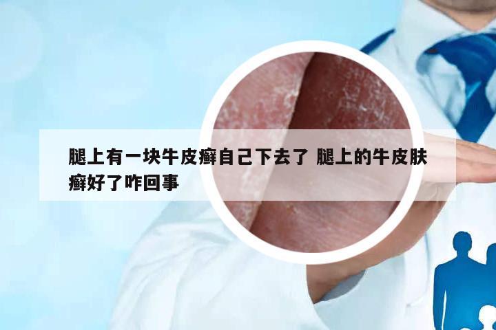 腿上有一塊牛皮癬自己下去了 腿上的牛皮膚癬好了咋回事