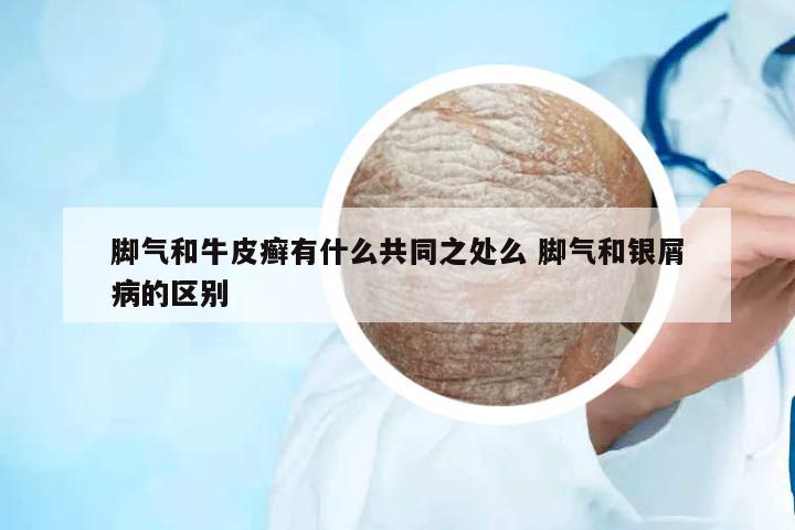 腳氣和牛皮癬有什么共同之處么 腳氣和銀屑病的區(qū)別