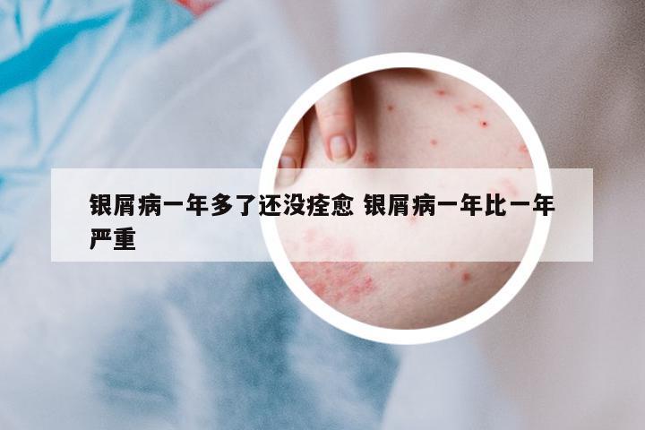 銀屑病一年多了還沒痊愈 銀屑病一年比一年嚴(yán)重