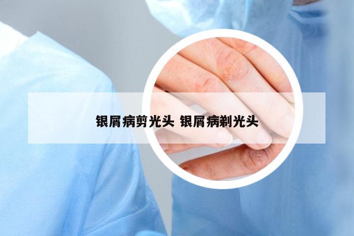 銀屑病剪光頭 銀屑病剃光頭