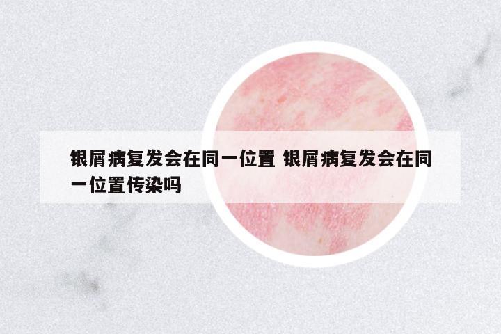 銀屑病復(fù)發(fā)會(huì)在同一位置 銀屑病復(fù)發(fā)會(huì)在同一位置傳染嗎