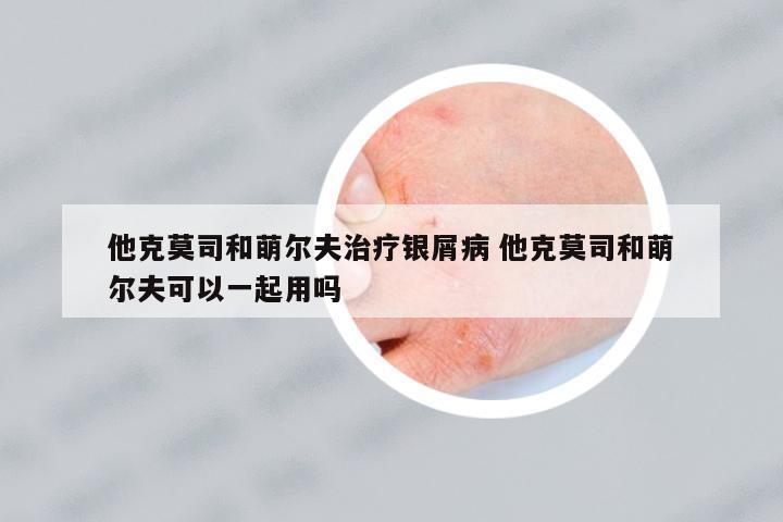 他克莫司和萌爾夫治療銀屑病 他克莫司和萌爾夫可以一起用嗎