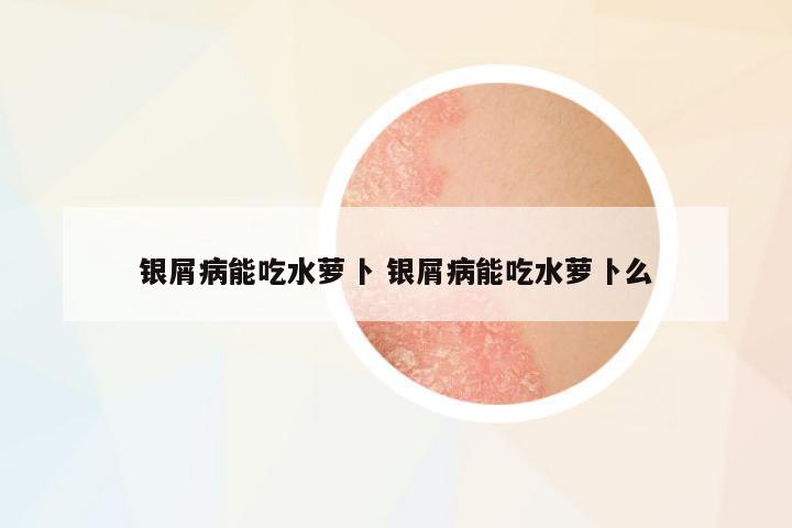 銀屑病能吃水蘿卜 銀屑病能吃水蘿卜么