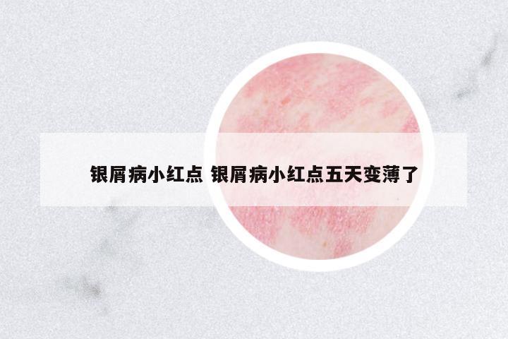 銀屑病小紅點 銀屑病小紅點五天變薄了