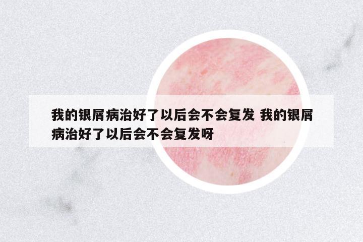 我的銀屑病治好了以后會不會復發(fā) 我的銀屑病治好了以后會不會復發(fā)呀