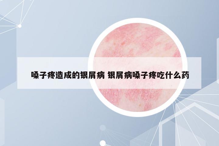 嗓子疼造成的銀屑病 銀屑病嗓子疼吃什么藥