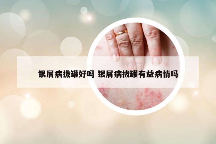 銀屑病拔罐好嗎 銀屑病拔罐有益病情嗎