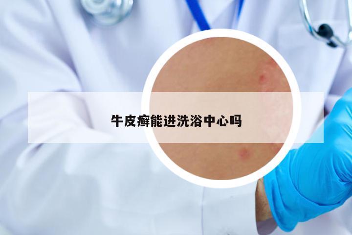 牛皮癬能進(jìn)洗浴中心嗎