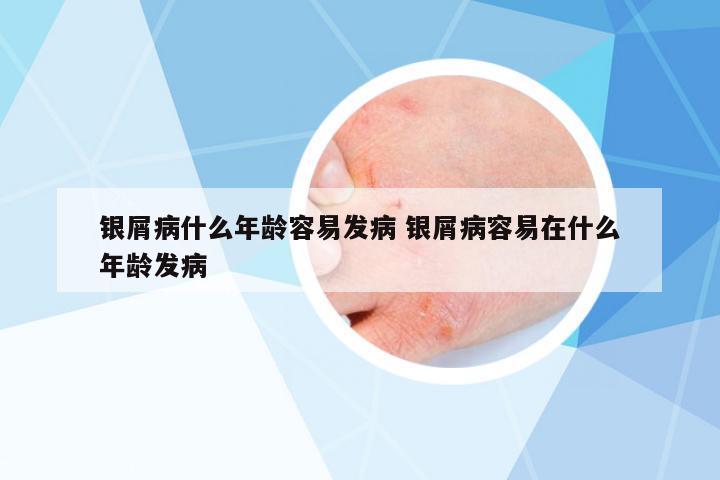 銀屑病什么年齡容易發(fā)病 銀屑病容易在什么年齡發(fā)病