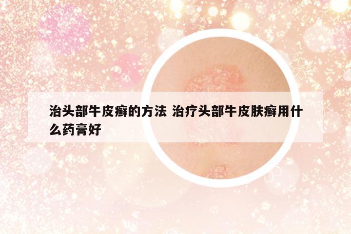 治頭部牛皮癬的方法 治療頭部牛皮膚癬用什么藥膏好
