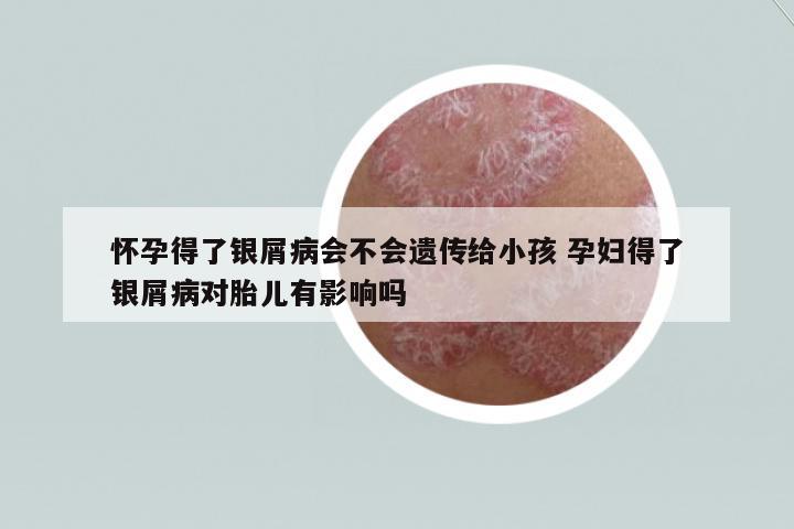 懷孕得了銀屑病會(huì)不會(huì)遺傳給小孩 孕婦得了銀屑病對(duì)胎兒有影響嗎