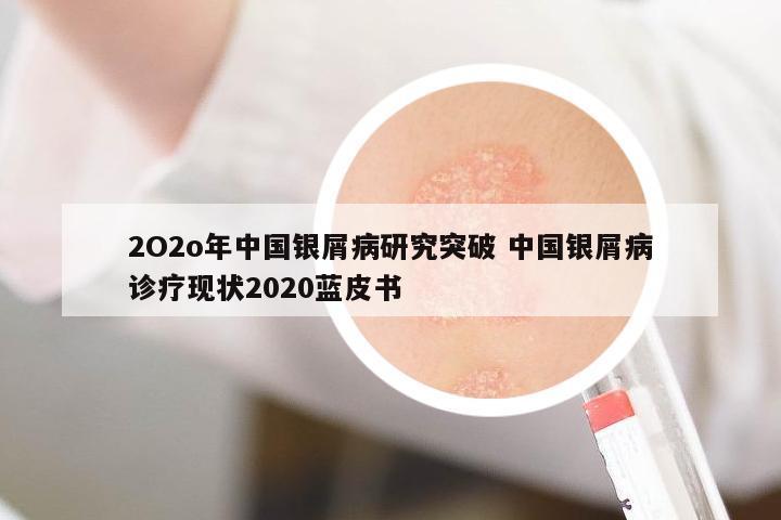 2O2o年中國銀屑病研究突破 中國銀屑病診療現(xiàn)狀2020藍(lán)皮書