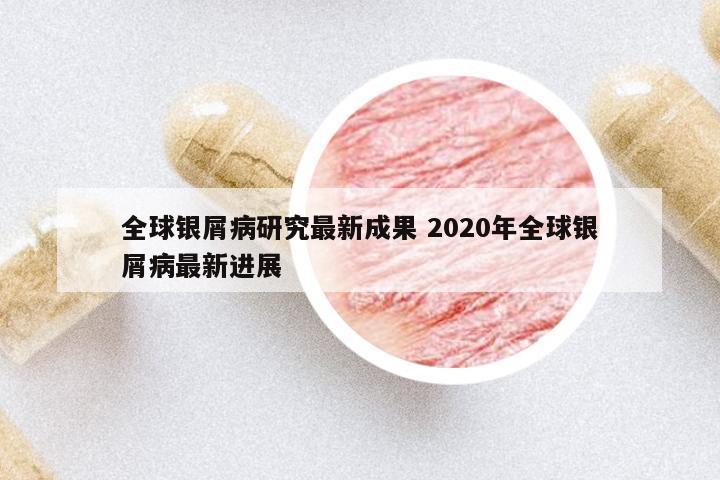 全球銀屑病研究最新成果 2020年全球銀屑病最新進展