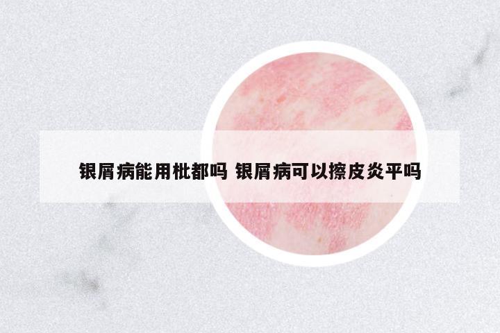 銀屑病能用枇都嗎 銀屑病可以擦皮炎平嗎