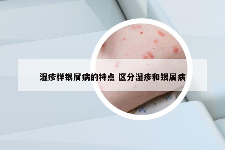 濕疹樣銀屑病的特點(diǎn) 區(qū)分濕疹和銀屑病