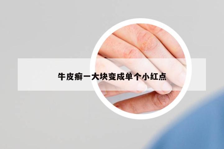 牛皮癬一大塊變成單個小紅點