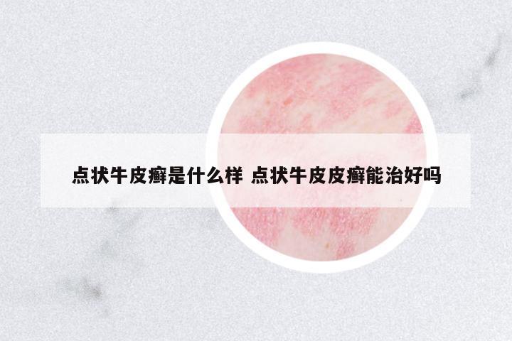 點(diǎn)狀牛皮癬是什么樣 點(diǎn)狀牛皮皮癬能治好嗎