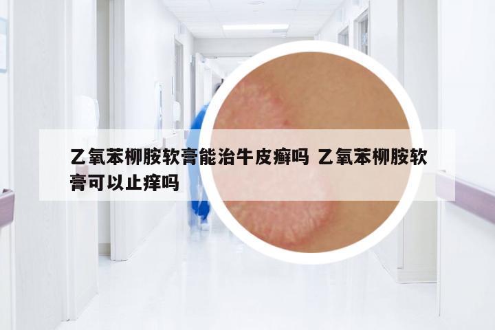 乙氧苯柳胺軟膏能治牛皮癬嗎 乙氧苯柳胺軟膏可以止癢嗎