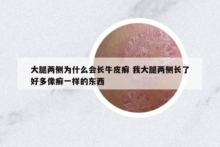 大腿兩側(cè)為什么會長牛皮癬 我大腿兩側(cè)長了好多像癬一樣的東西