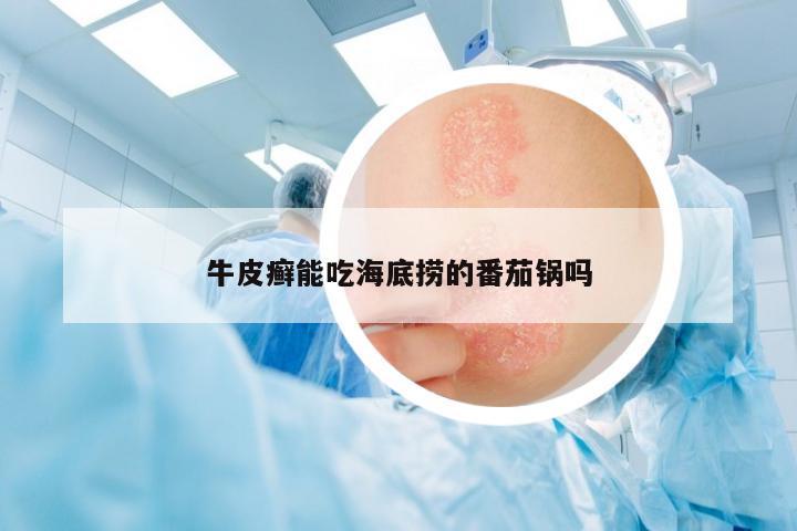 牛皮癬能吃海底撈的番茄鍋嗎
